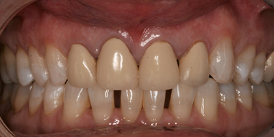 Upper All Ceramic Crowns and Composite Resin 1 