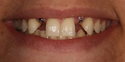 Implant All Ceramic Crowns with Custom Abutments 1