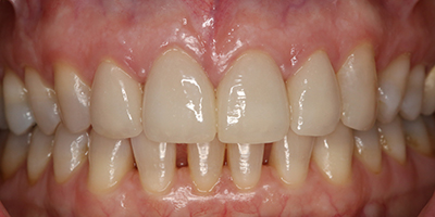 Upper All Ceramic Crowns and Composite Resin 2
