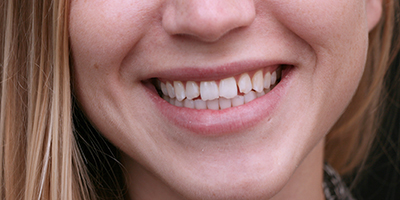 Orthodontics and Upper Veneers 3