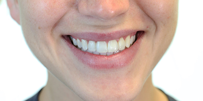 Orthodontics and Upper Veneers 4