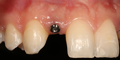Implant All Ceramic Crowns with Custom Abutments 5