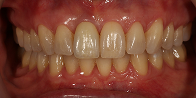 Crown with a Zirconia Custom Abutment 1