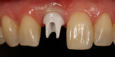 Crown with a Zirconia Custom Abutment 2