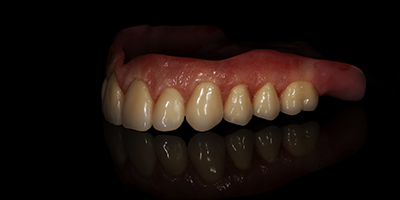 Custom Stained and Characterized Dentures 1
