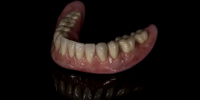 Custom Stained and Characterized Dentures 2