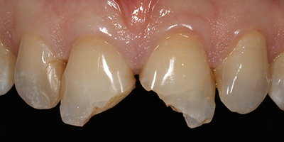 Immediate Emergency Tooth Repair with Composite Resin Restorations 1