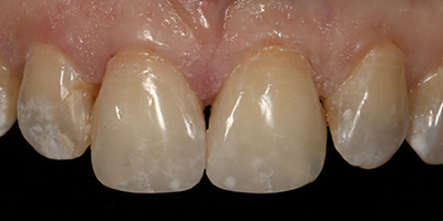 Immediate Emergency Tooth Repair with Composite Resin Restorations 2