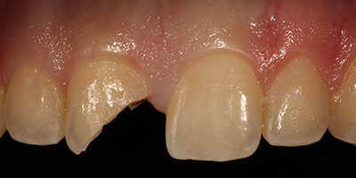 Immediate Emergency Tooth Repair with a Composite Resin Filling 1