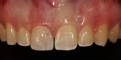 Immediate Emergency Tooth Repair with a Composite Resin Filling 2