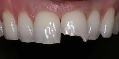 Immediate Emergency Tooth Repair with a Composite Resin Filling 3
