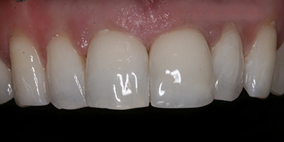 Immediate Emergency Tooth Repair with a Composite Resin Filling 4