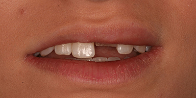 Immediate Emergency Tooth Repair with a Composite Resin Restoration 1