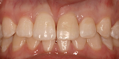 Immediate Emergency Tooth Repair with a Composite Resin Restoration 2