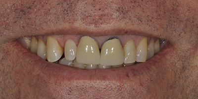 Immediate Implant with All Ceramic Crowns, Veneers, and Composite Resin Restorations 1