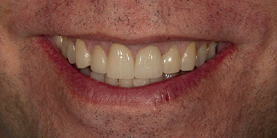 Immediate Implant with All Ceramic Crowns, Veneers, and Composite Resin Restorations 2