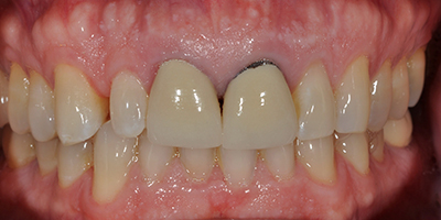 Immediate Implant with All Ceramic Crowns, Veneers, and Composite Resin Restorations 3