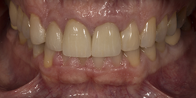 Immediate Implant with All Ceramic Crowns, Veneers, and Composite Resin Restorations 4