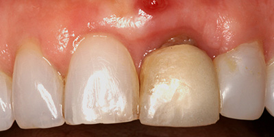 Individual Implant with an All Ceramic Crown and Zirconia Abutment 1