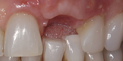 Individual Implant with an All Ceramic Crown and Zirconia Abutment 2