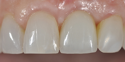 Individual Implant with an All Ceramic Crown and Zirconia Abutment 3