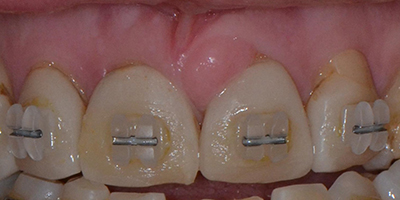 Post Orthodontics Smile Design with Customized Provisionals 1