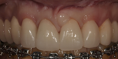 Post Orthodontics Smile Design with Customized Provisionals 2