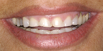 Upper Crown Lengthening and All Ceramic Crowns 1
