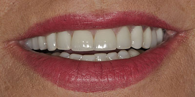 Upper Crown Lengthening and All Ceramic Crowns 2
