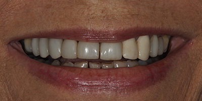 Upper and Lower All Ceramic Crowns 1