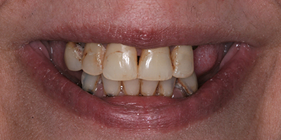 Upper and Lower Zirconia Implant Supported Bridges 1
